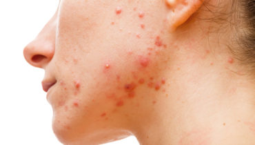 PUT YOUR BEST FACE FORWARD: 3 Secret Recipes for Thyroid Acne Skin