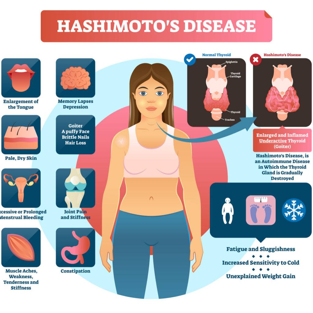 hashimoto symptoms